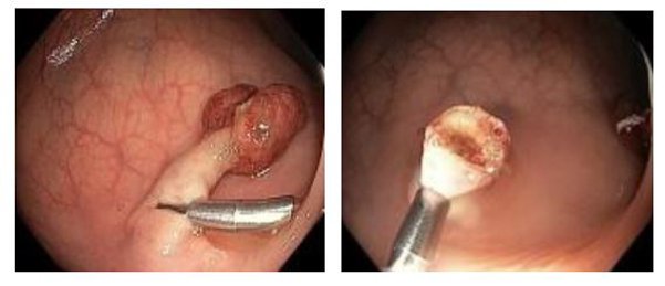 Polyp đại tràng có cuống trước và sau cắt qua nội soi