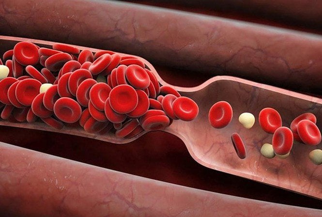 Sự hình thành và cách ngăn ngừa cục máu đông ở bệnh nhân ung thư