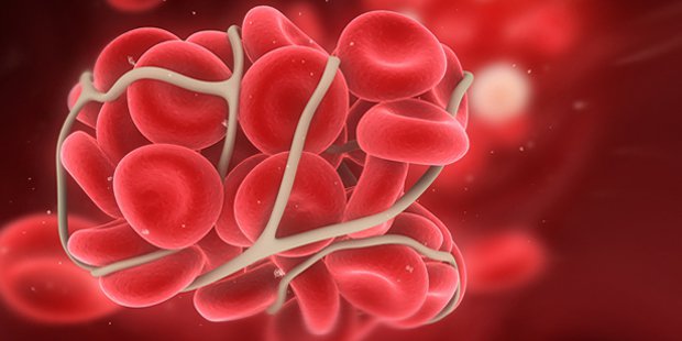 Sự hình thành và cách ngăn ngừa cục máu đông ở bệnh nhân ung thư