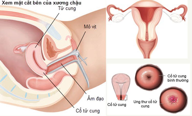 Những điều cần biết về sinh thiết cổ tử cung