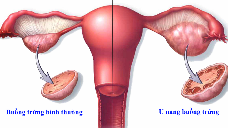 Tiến triển và biến chứng của u buồng trứng