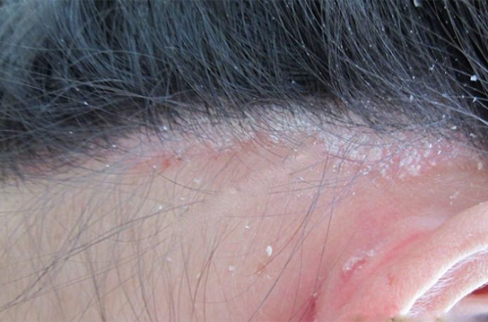 Vẩy nến da đầu