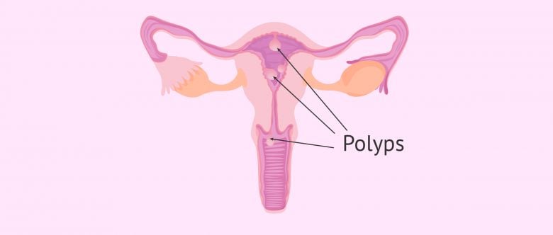 Polyp buồng tử cung