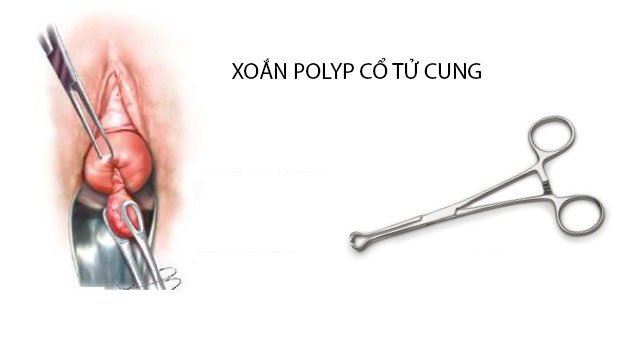 Thủ thuật xoắn polyp cổ tử cung