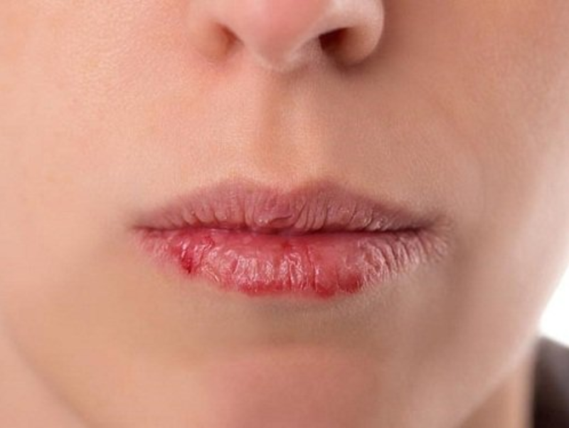 Viêm môi là gì