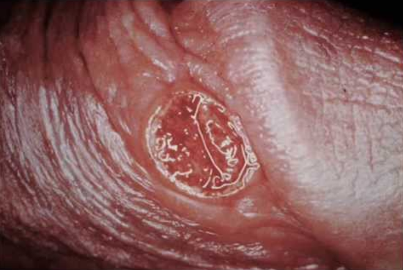Triệu chứng của bệnh Behcet ở bộ phận sinh dục nam