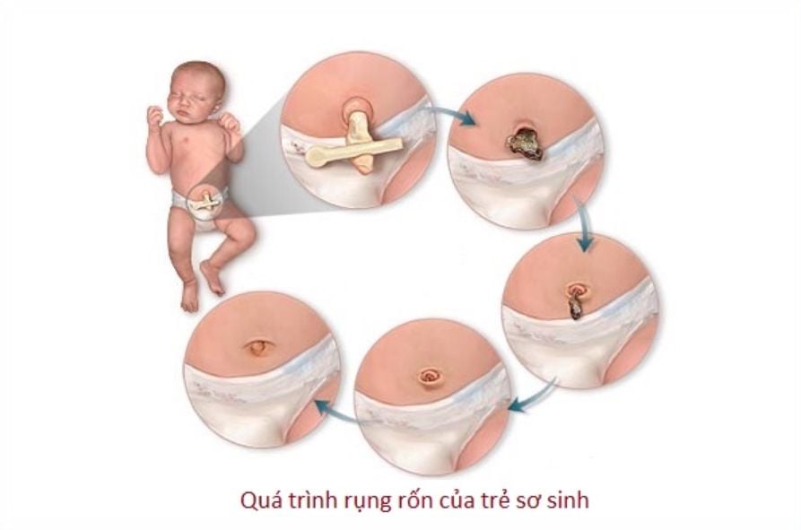 Quá trình rụng rốn của trẻ sơ sinh 