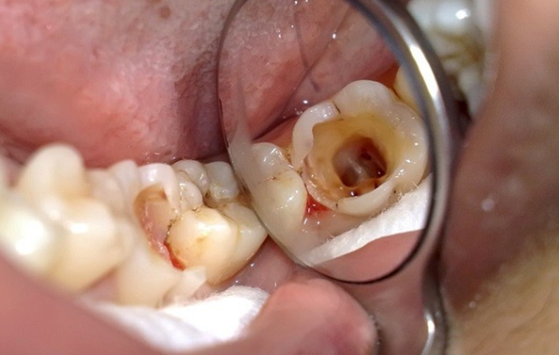Một răng hàm bị sâu vào tủy