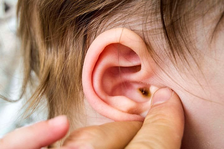 Viêm tai ngoài ở trẻ