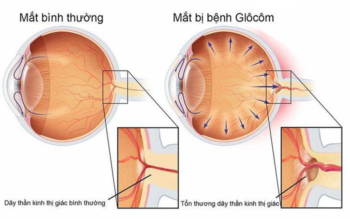 Bệnh Glocom ở mắt