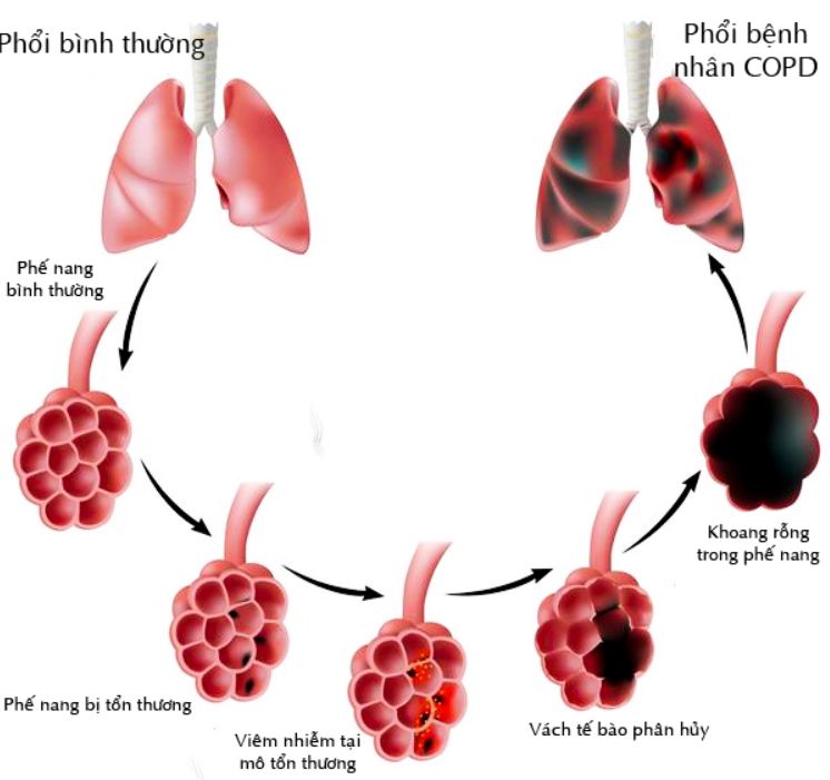 COPD