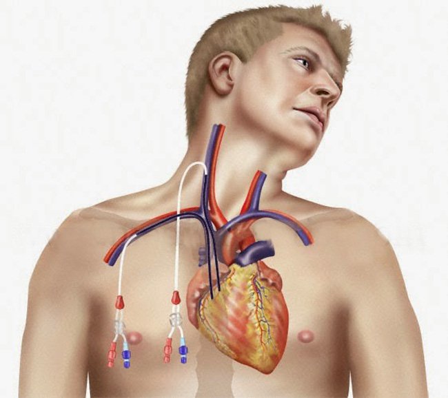 Catheter tĩnh mạch