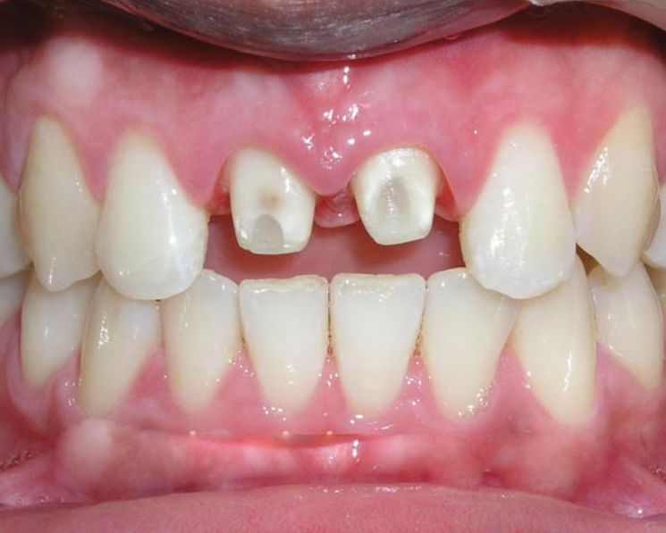 Có nên mài răng làm răng sứ?