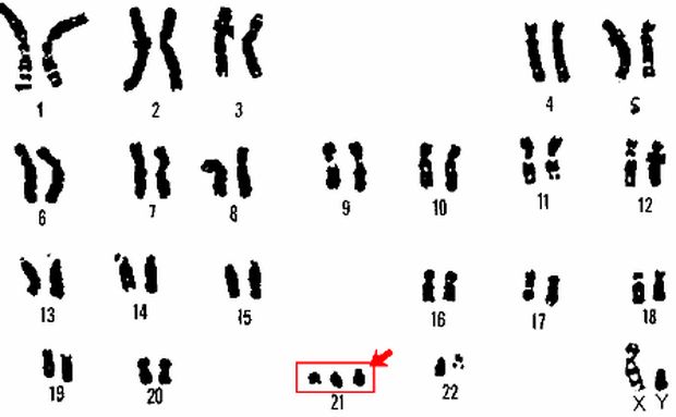 Tam nhiễm sắc thể 21