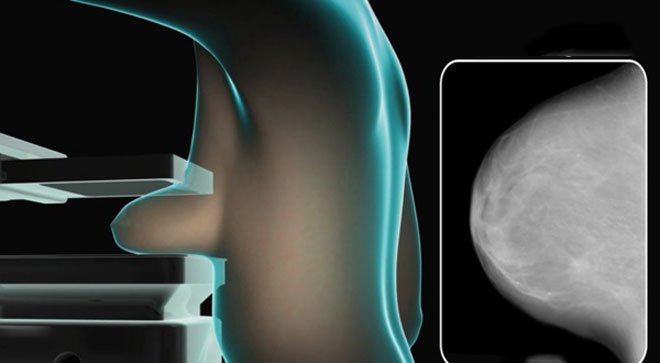 Tư thế chụp X quang tuyến vú (mammography)