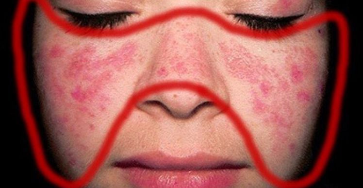 lupus ban đỏ dạng đĩa