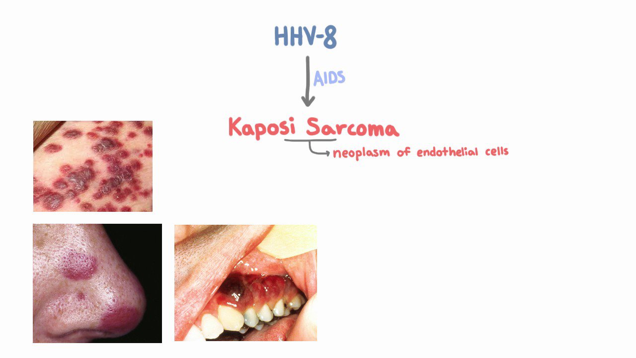 Nhiễm virus herpes 8