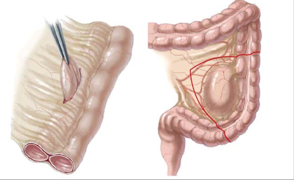 Nang ruột đôi có dạng ống dài ở ruột non (trái)