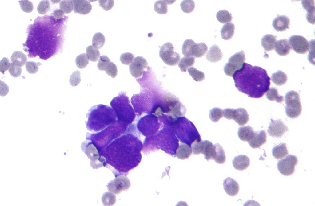 Hình ảnh hiển vi của ung thư phổi tế bào nhỏ phổi chỉ ra các tế bào kết thành nhân, lượng nhỏ tế bào chất và các đốm nhiễm sắc. mẫu FNA