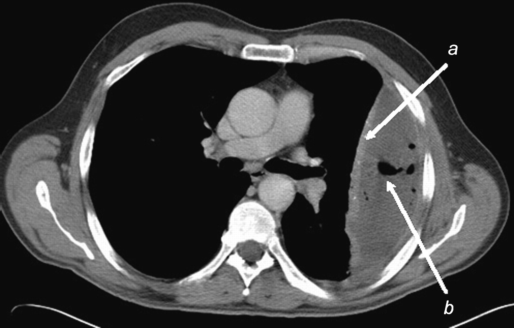 kết quả CT dịch màng phổi