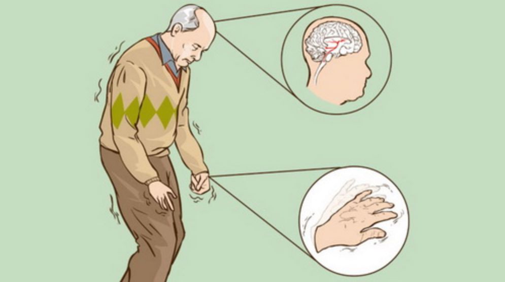 Hội chứng Parkinson