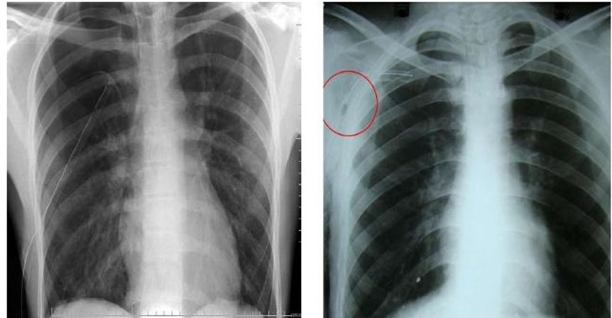 hình ảnh X-quang phổi