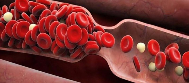 Bị tắc mạch máu có chữa được không và bằng cách nào?