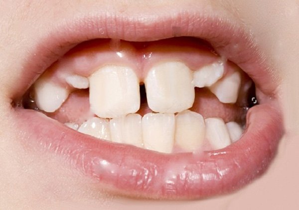 Điều trị răng mọc lệch ở trẻ có ảnh hưởng gì không?