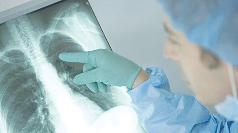 chụp x quang viêm phổi
