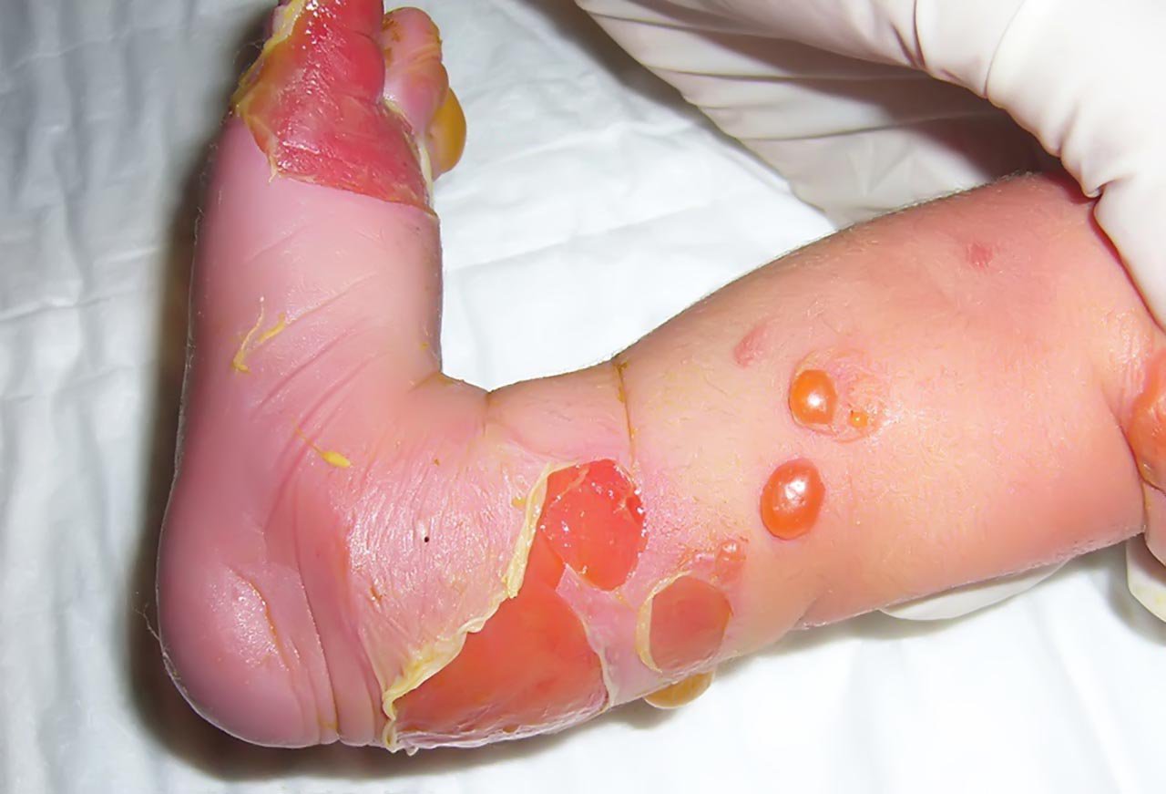 Bệnh bong biểu bì bullosa thoáng qua ở trẻ sơ sinh