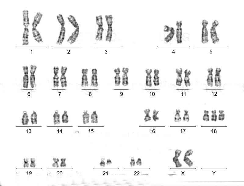 . Karyotype bất thường của nữ giới mắc hội chứng Edwards (Trisomy 18) (https://www.medicalimages.com/)