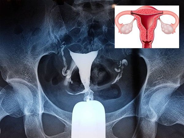 Sau chụp X quang tử cung vòi trứng có quan hệ tình dục được không