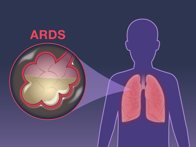 Hội chứng suy hô hấp nặng ở người lớn ARDS