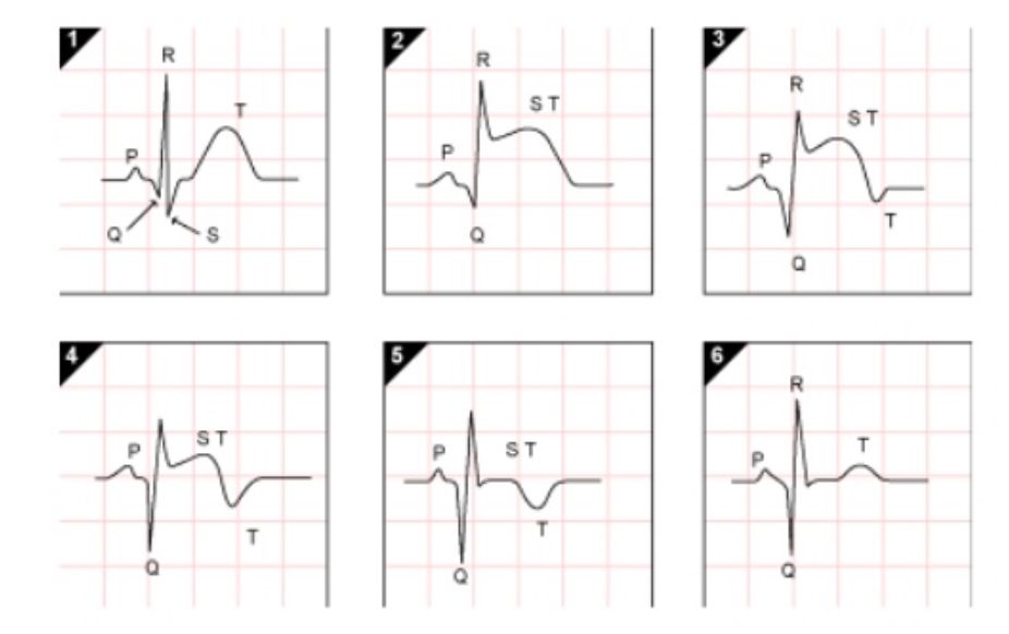 ECG nhồi máu cơ tim