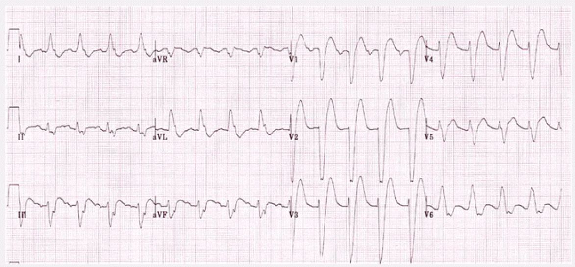 Điện tâm đồ biểu thị tình trạng QRS Block nhánh trái ECG