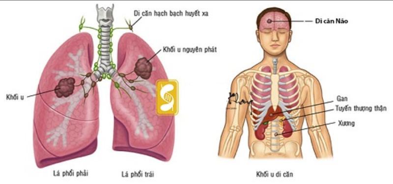 Ung thư phổi di căn giai đoạn 4