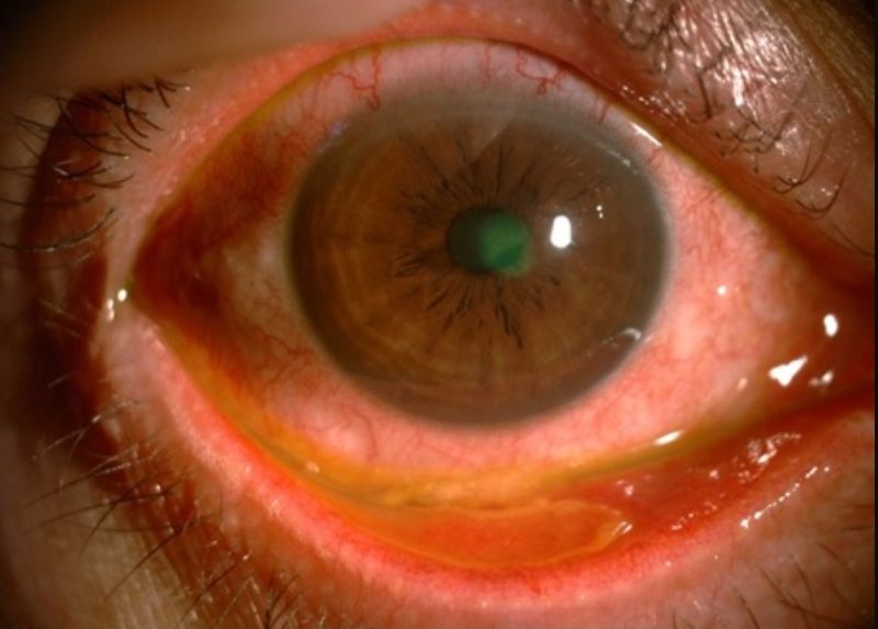 Viêm kết mạc do virus herpes