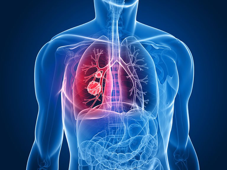 Bị u phổi di căn sang xương nên điều trị thế nào cho hợp lý?