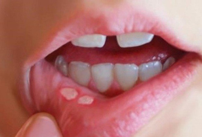 Nhiệt miệng kèm đau họng và hàm là bị bệnh gì?