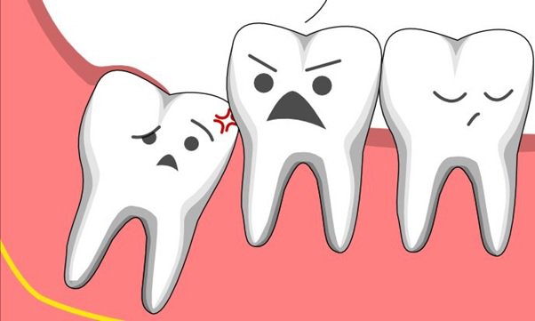 Răng khôn đã mọc có nên nhổ không?