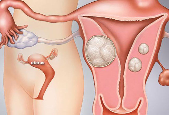 Mang thai tháng thứ 4 có thể điều trị u xơ tử cung được không?