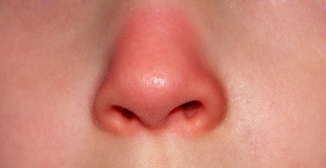 Mũi sưng đỏ và mất khứu giác là dấu hiệu bệnh gì?