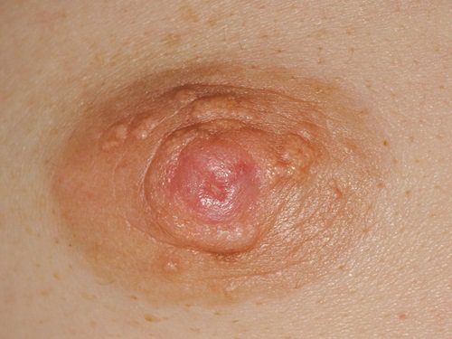 Nổi cục ở núm vú kèm theo chảy dịch đỏ nhầy là dấu hiệu bệnh gì?