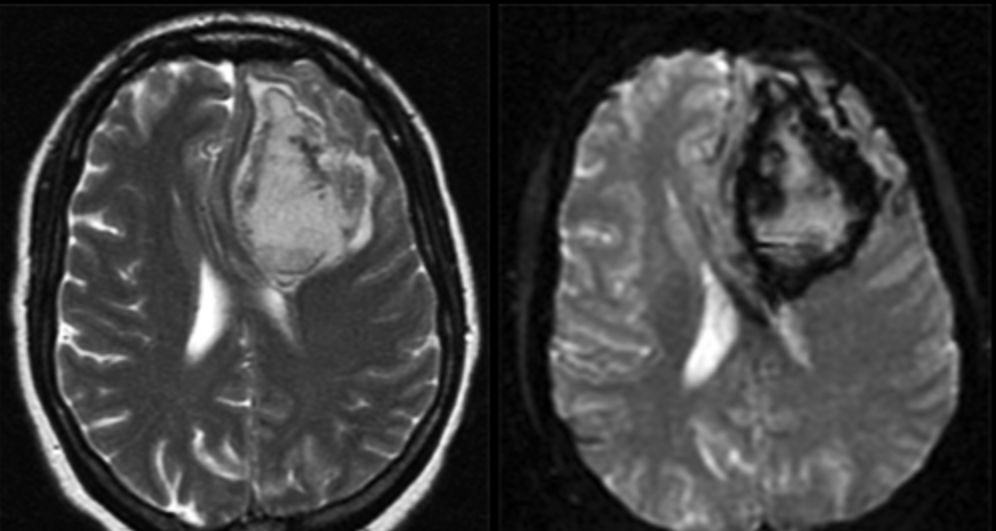 MRI xuất huyết não