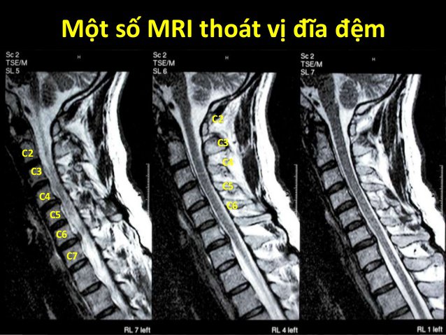 Kết quả chụp MRI
