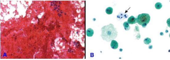 FNA tuyến giáp bình dương