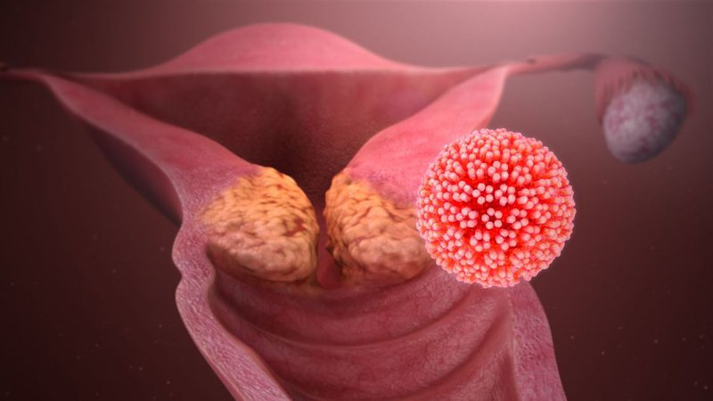 Ung thư cổ tử cung  HPV