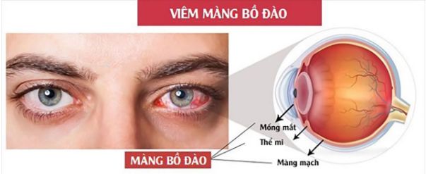 viêm màng bồ đào