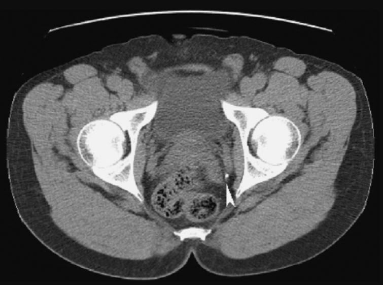 CT-scan vùng chậu cho hình ảnh sỏi niệu quản đoạn niệu quản xa bên trái