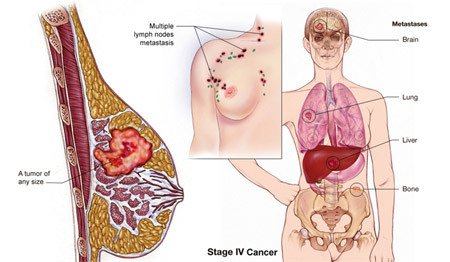 ung thư vú giai đoạn cuối